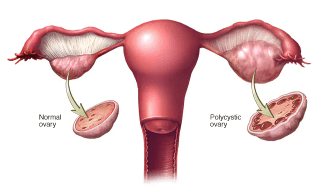 You are currently viewing Polycystic ovary syndrome (PCOS), Prevention and Cure