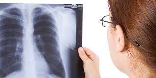 Read more about the article Tuberculosis: No.1 Unraveling the Silent Threat to Global Health